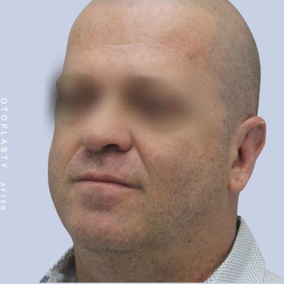Ears Before & After Gallery - Patient 120868401 - Image 4