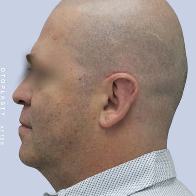 Ears Before & After Gallery - Patient 120868401 - Image 6