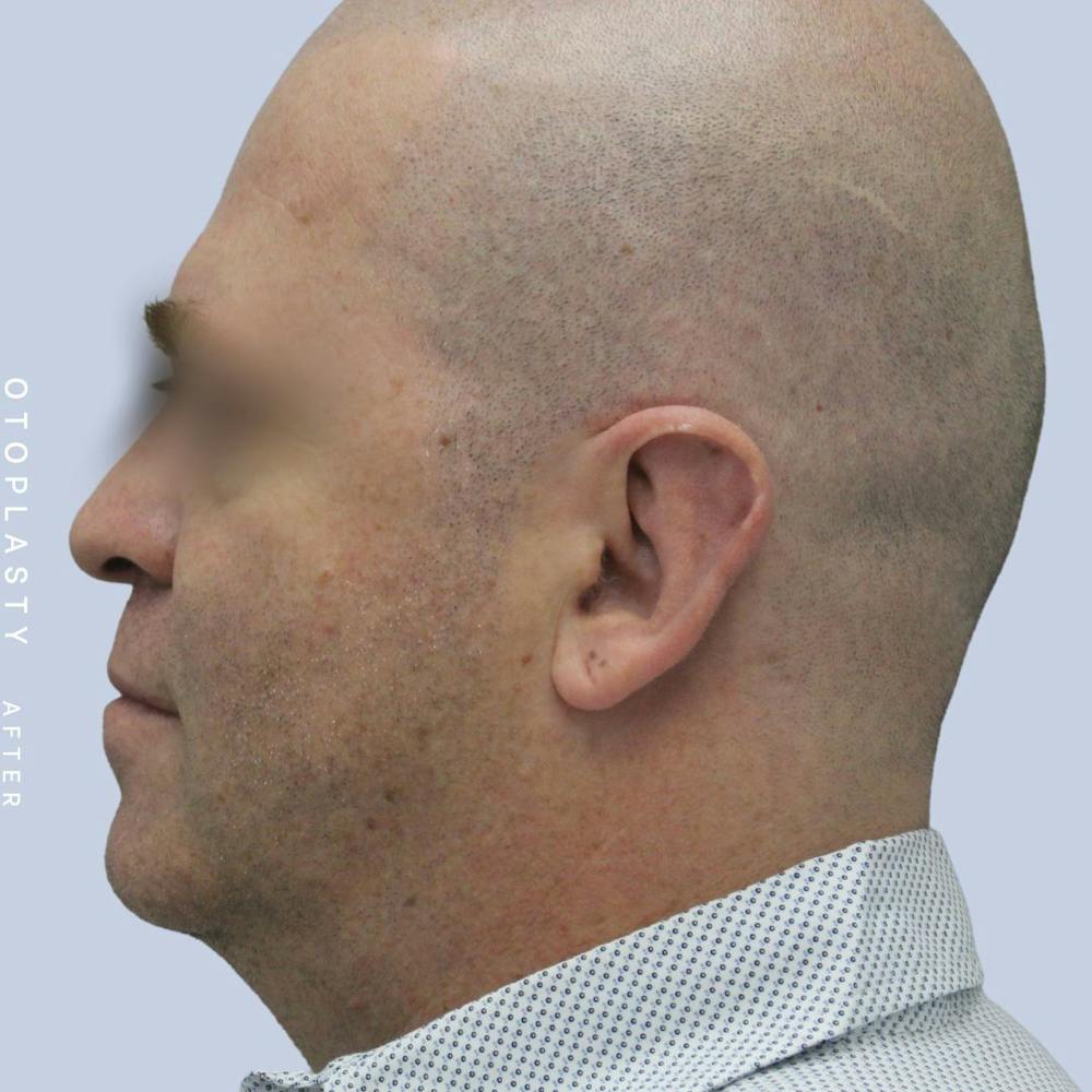 Men's Ears Before & After Gallery - Patient 120868403 - Image 6