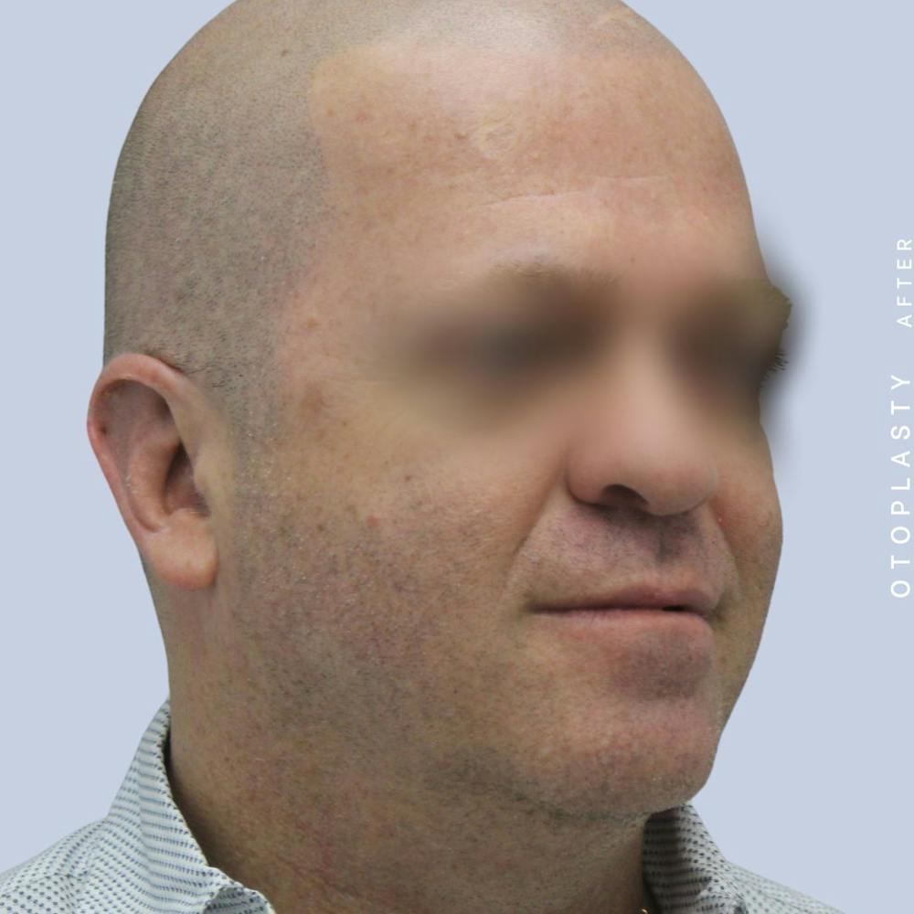 Ears Before & After Gallery - Patient 120868401 - Image 8