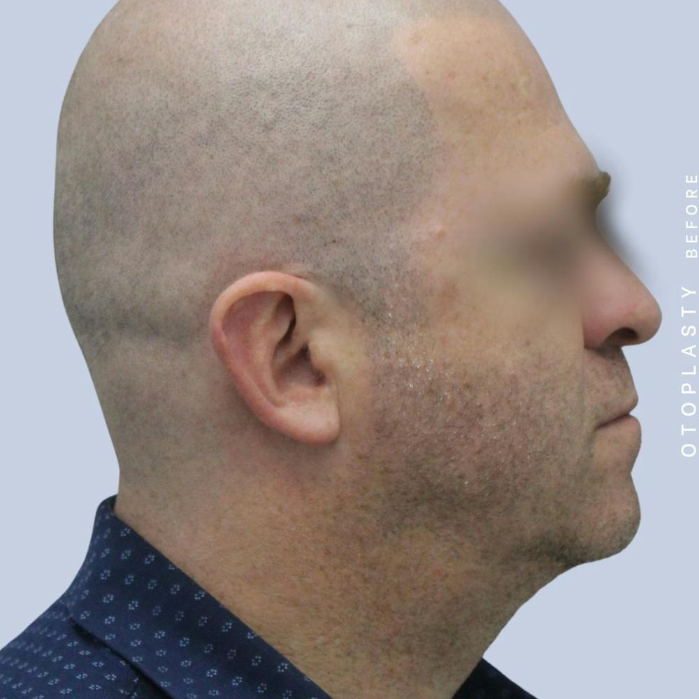 Ears Before & After Gallery - Patient 120868401 - Image 9