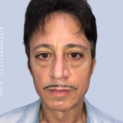 Men's Eyes Before & After Gallery - Patient 108764321 - Image 1