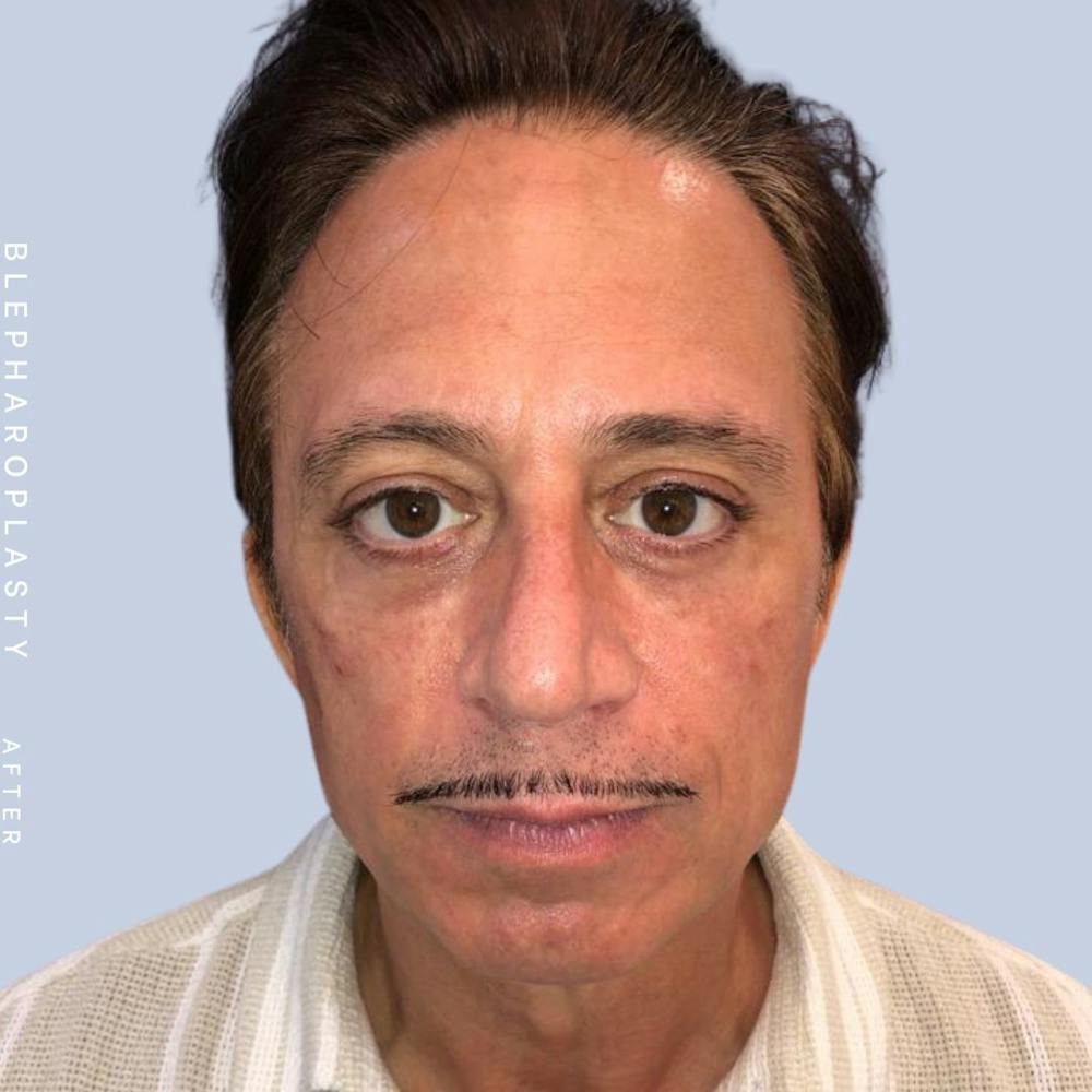 Men's Eyes Before & After Gallery - Patient 108764321 - Image 2