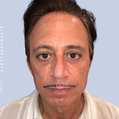 Men's Eyes Before & After Gallery - Patient 108764321 - Image 2