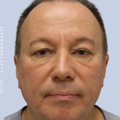 Eyes Before & After Gallery - Patient 108744019 - Image 1