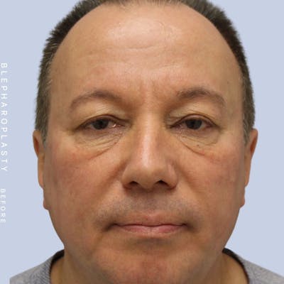 Men's Eyes Before & After Gallery - Patient 108764322 - Image 1