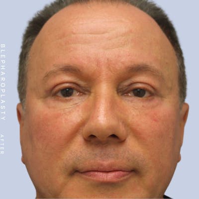 Men's Eyes Before & After Gallery - Patient 108764322 - Image 2