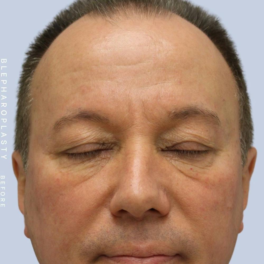 Eyes Before & After Gallery - Patient 108744019 - Image 3