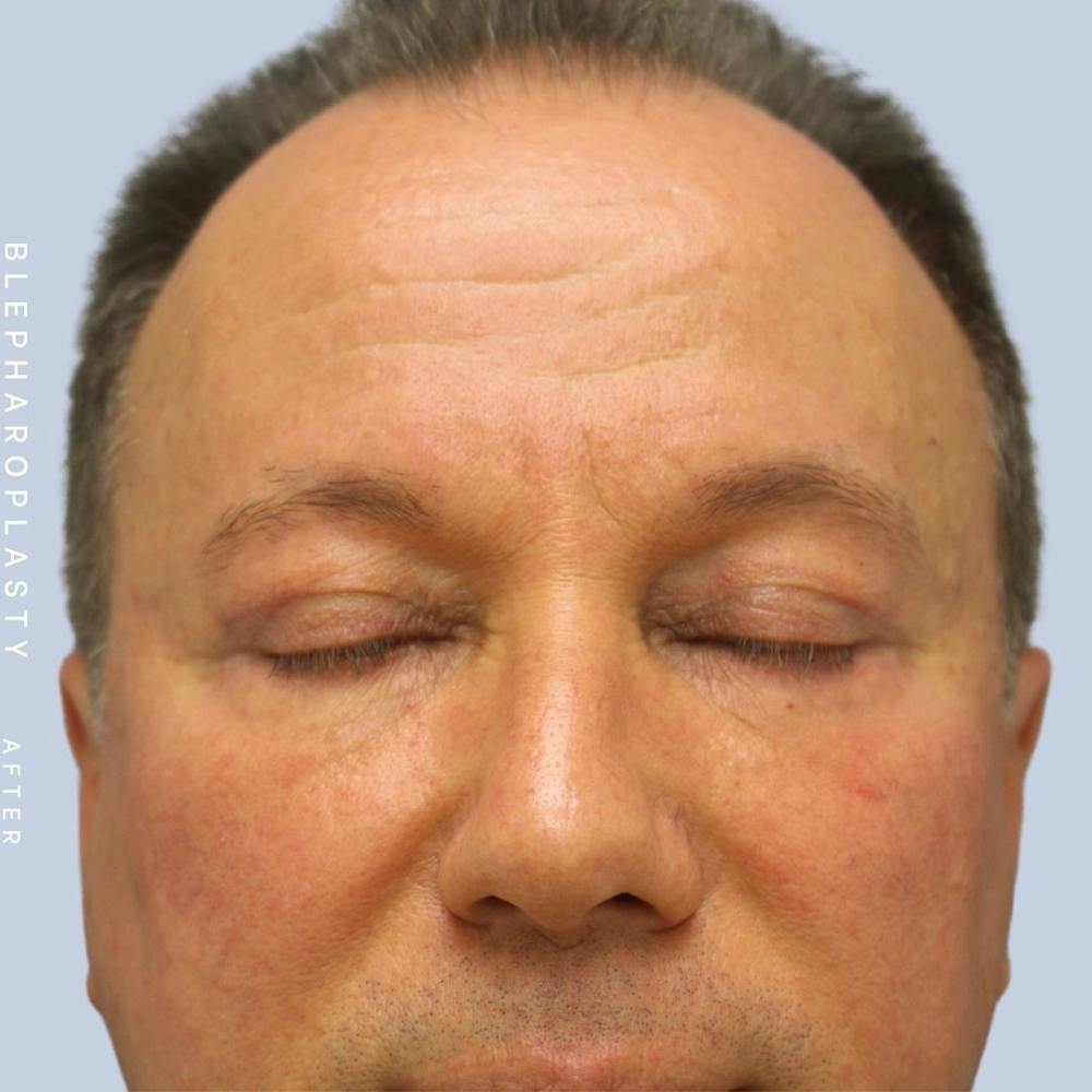 Eyes Before & After Gallery - Patient 108744019 - Image 4