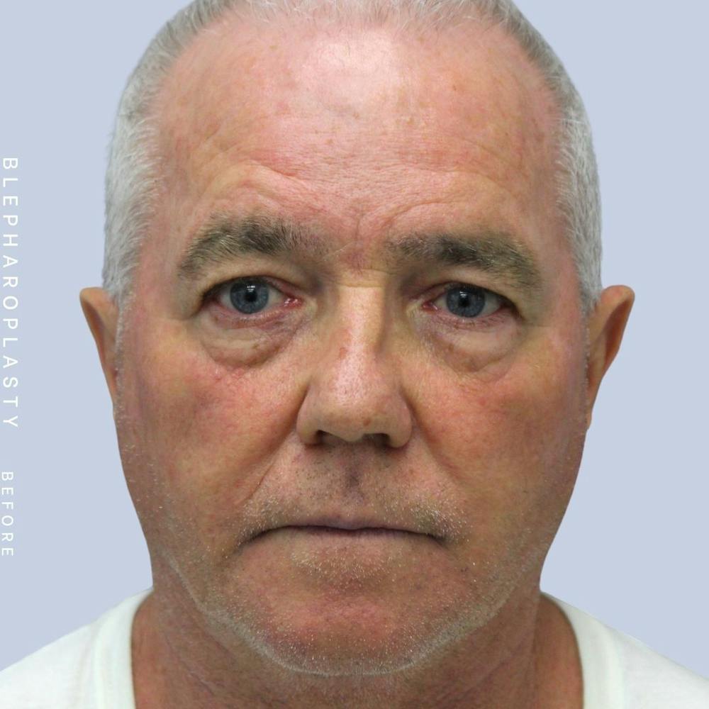 Eyes Before & After Gallery - Patient 108744020 - Image 1