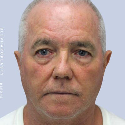 Eyes Before & After Gallery - Patient 108744020 - Image 1
