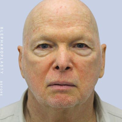 Eyes Before & After Gallery - Patient 108744021 - Image 1