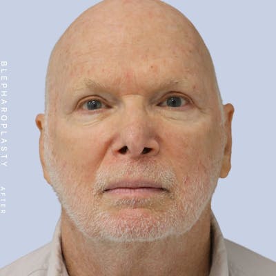 Eyes Before & After Gallery - Patient 108764324 - Image 2