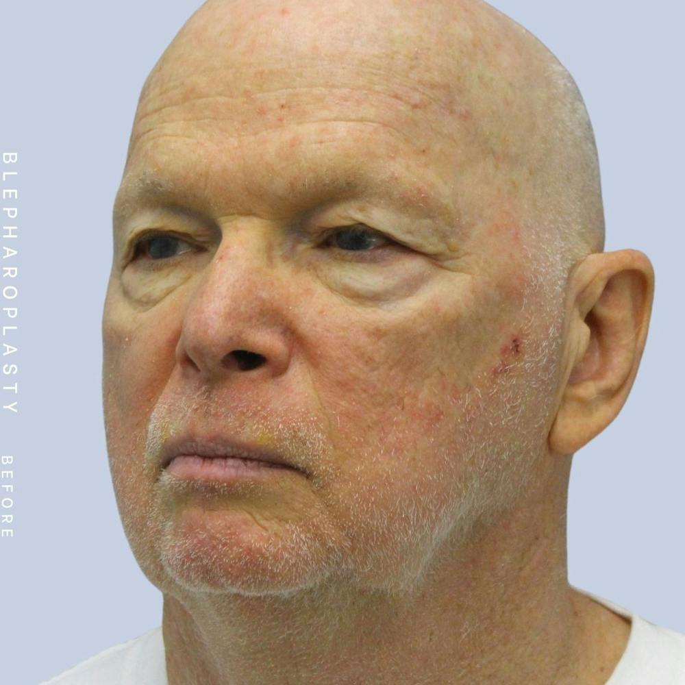 Eyes Before & After Gallery - Patient 108744021 - Image 3