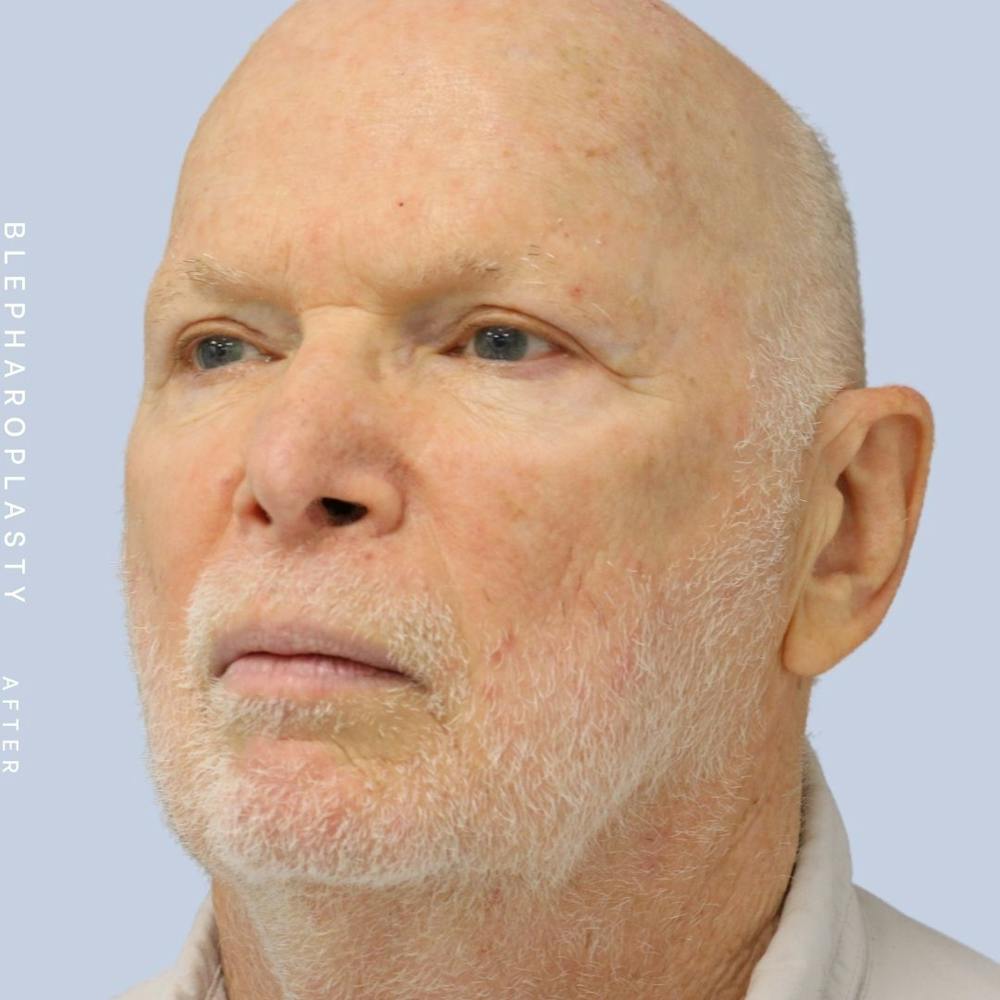 Eyes Before & After Gallery - Patient 108744021 - Image 4