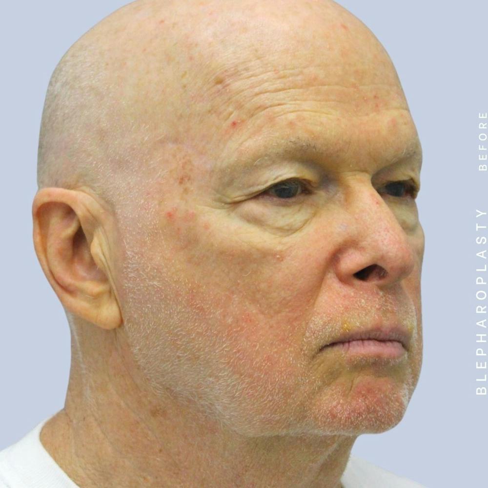 Eyes Before & After Gallery - Patient 108744021 - Image 5