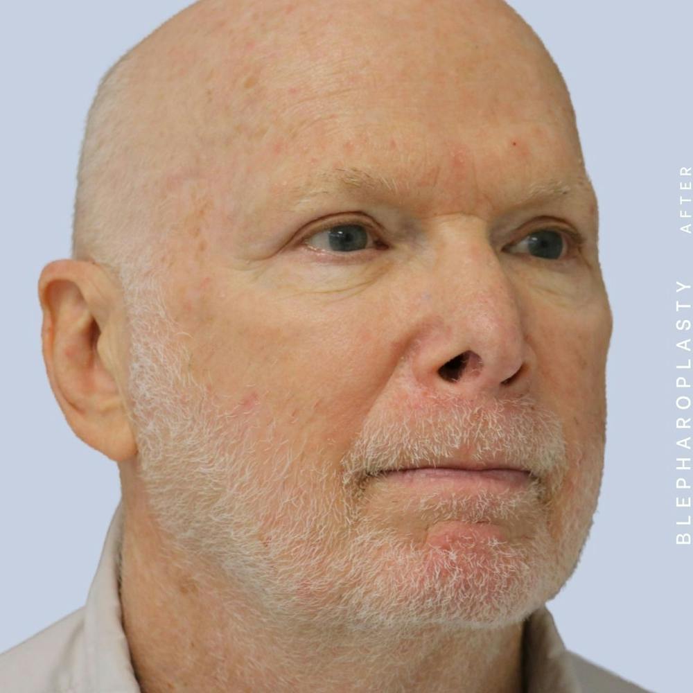 Eyes Before & After Gallery - Patient 108744021 - Image 6