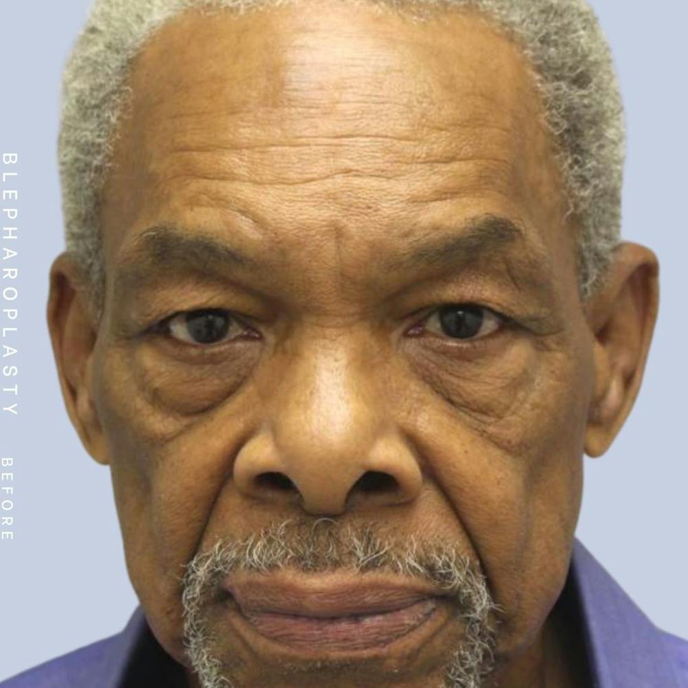 Men's Eyes Before & After Gallery - Patient 120868205 - Image 1