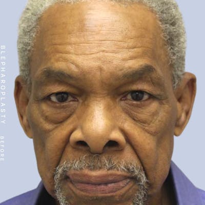 Eyes Before & After Gallery - Patient 120868203 - Image 1