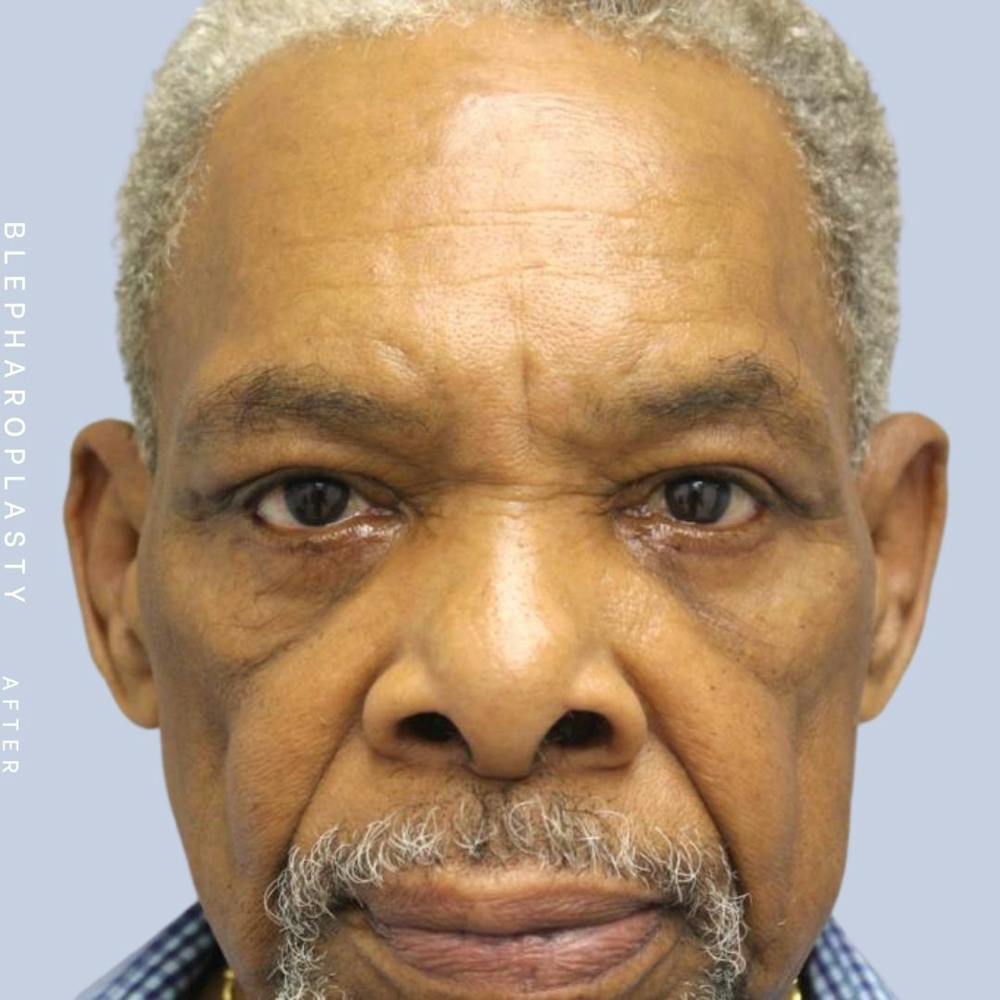 Men's Eyes Before & After Gallery - Patient 120868205 - Image 2
