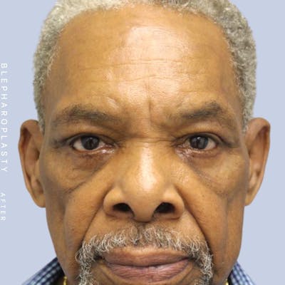 Men's Eyes Before & After Gallery - Patient 120868205 - Image 2