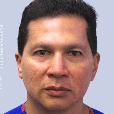 Eyes Before & After Gallery - Patient 121500238 - Image 1