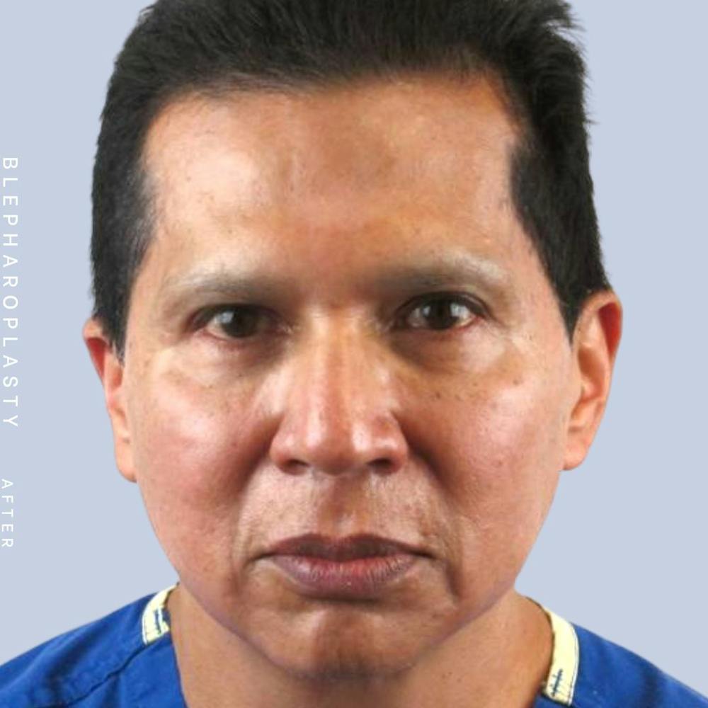 Eyes Before & After Gallery - Patient 121500238 - Image 2