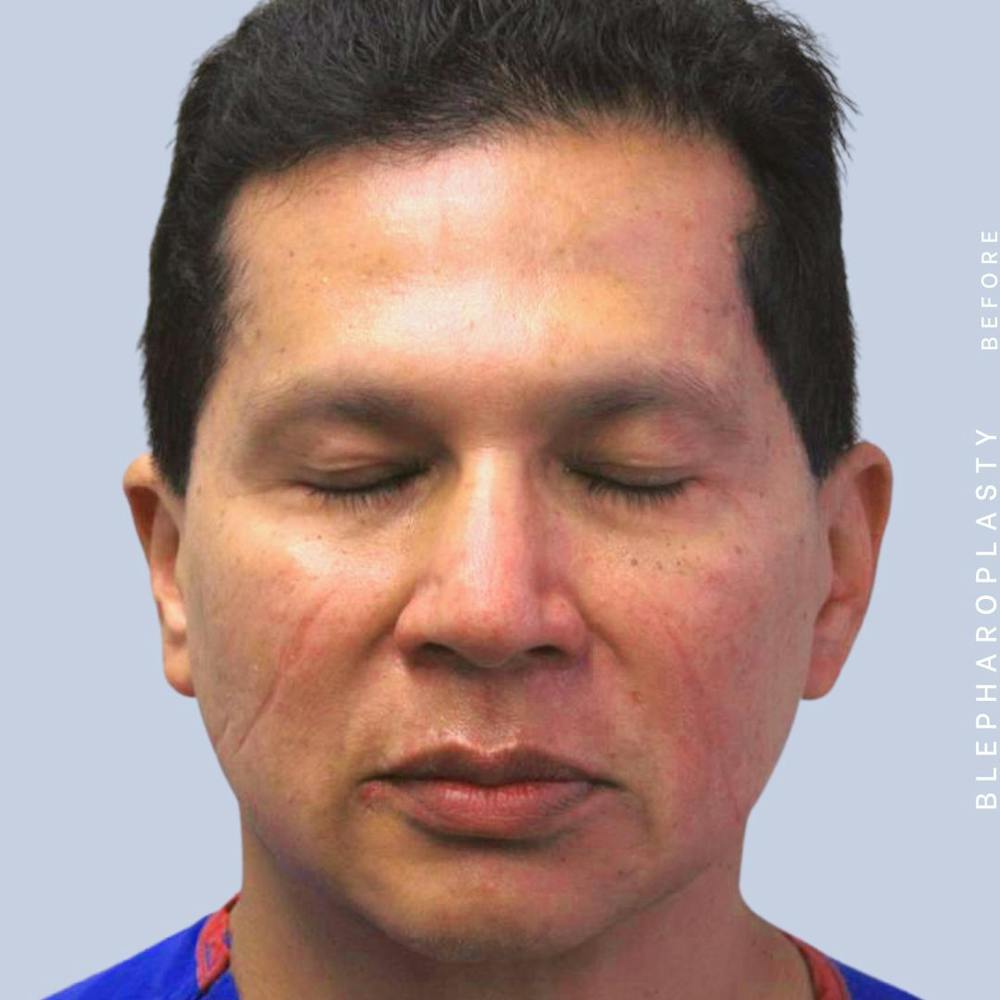Eyes Before & After Gallery - Patient 121500238 - Image 3