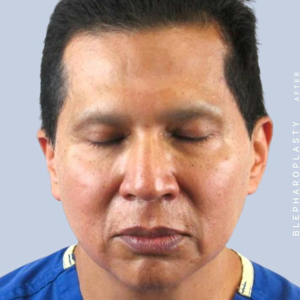 Eyes Before & After Gallery - Patient 121500238 - Image 4