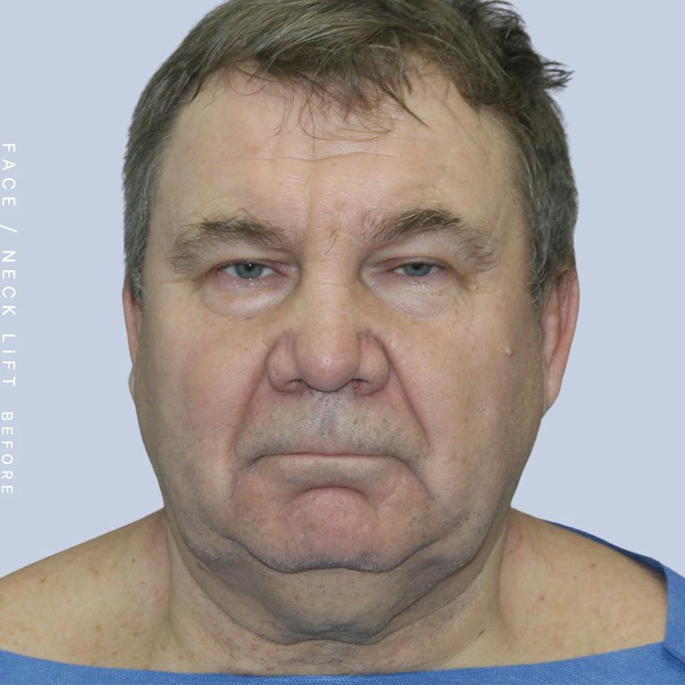 Men's Face & Neck Before & After Gallery - Patient 108763964 - Image 1