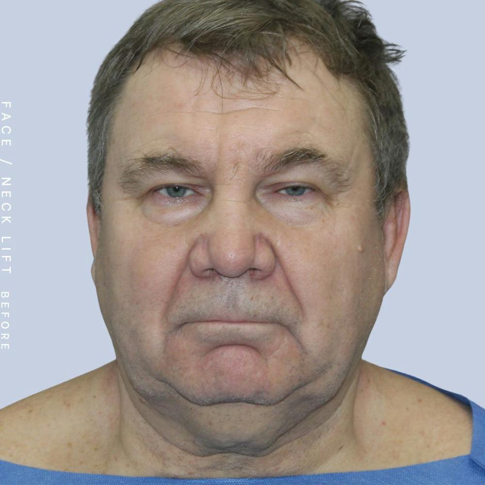 Face & Neck Before & After Gallery - Patient 108763964 - Image 1
