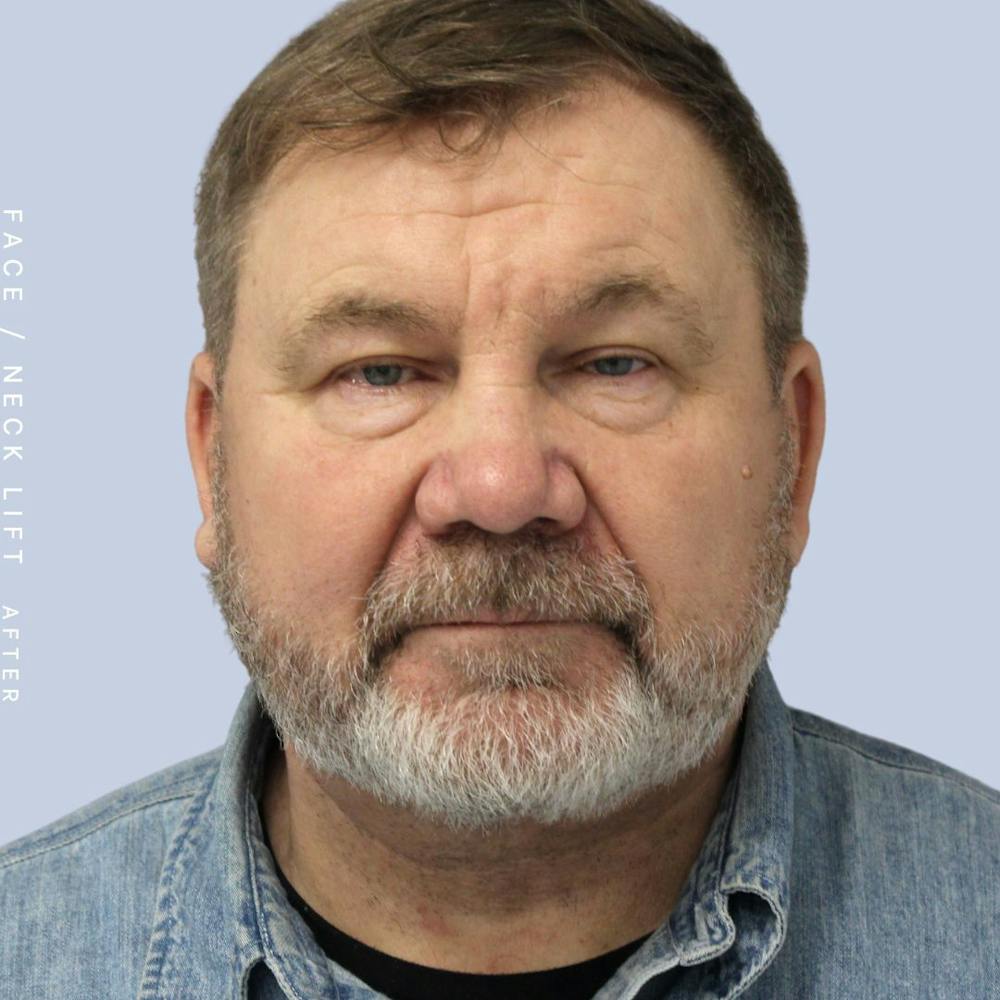 Men's Face & Neck Before & After Gallery - Patient 108763964 - Image 2