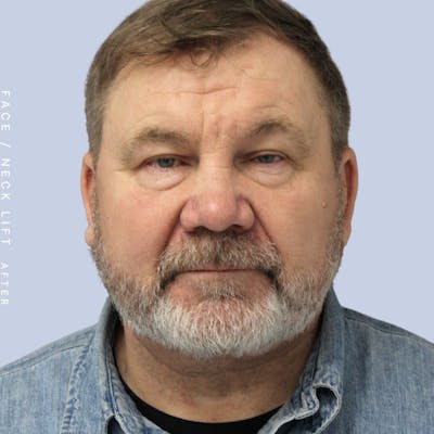 Men's Face & Neck Before & After Gallery - Patient 108763964 - Image 2