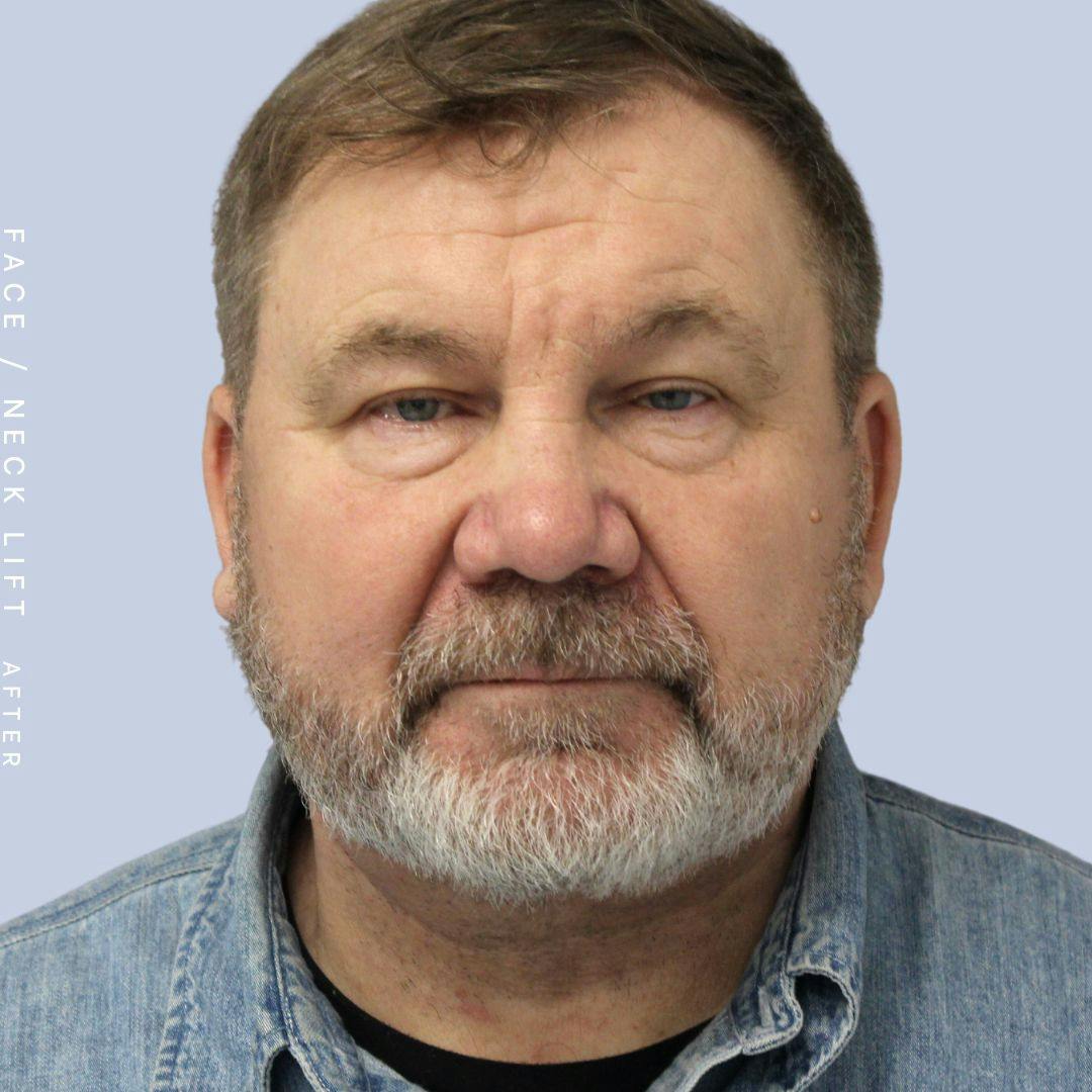 Face & Neck Before & After Gallery - Patient 108688955 - Image 2