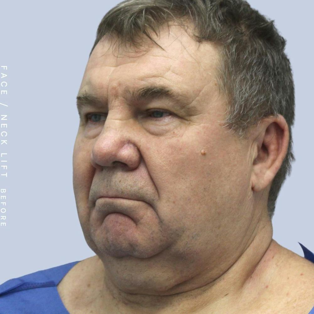 Men's Face & Neck Before & After Gallery - Patient 108763964 - Image 3