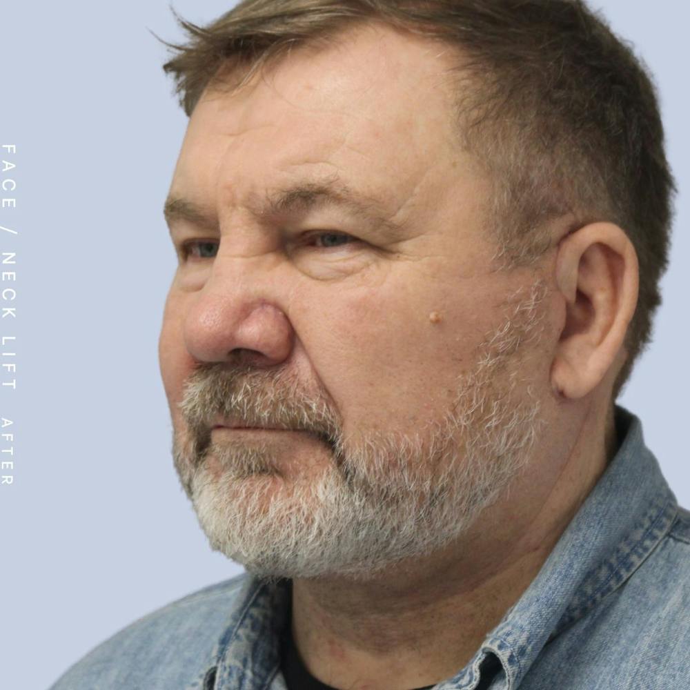 Men's Face & Neck Before & After Gallery - Patient 108763964 - Image 4