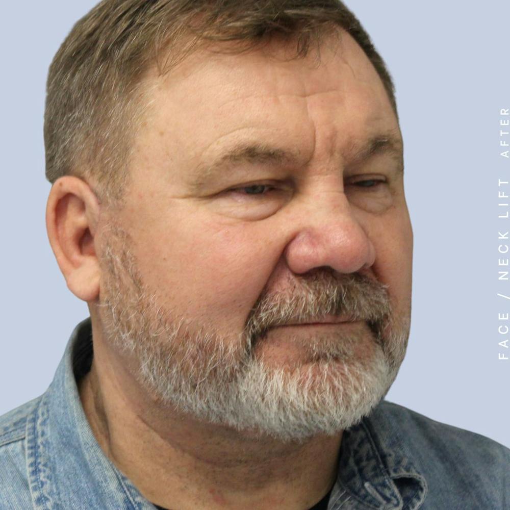 Men's Face & Neck Before & After Gallery - Patient 108763964 - Image 6