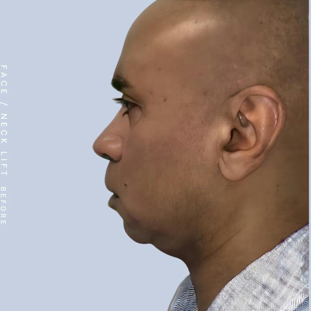 Face & Neck Before & After Gallery - Patient 108707435 - Image 1