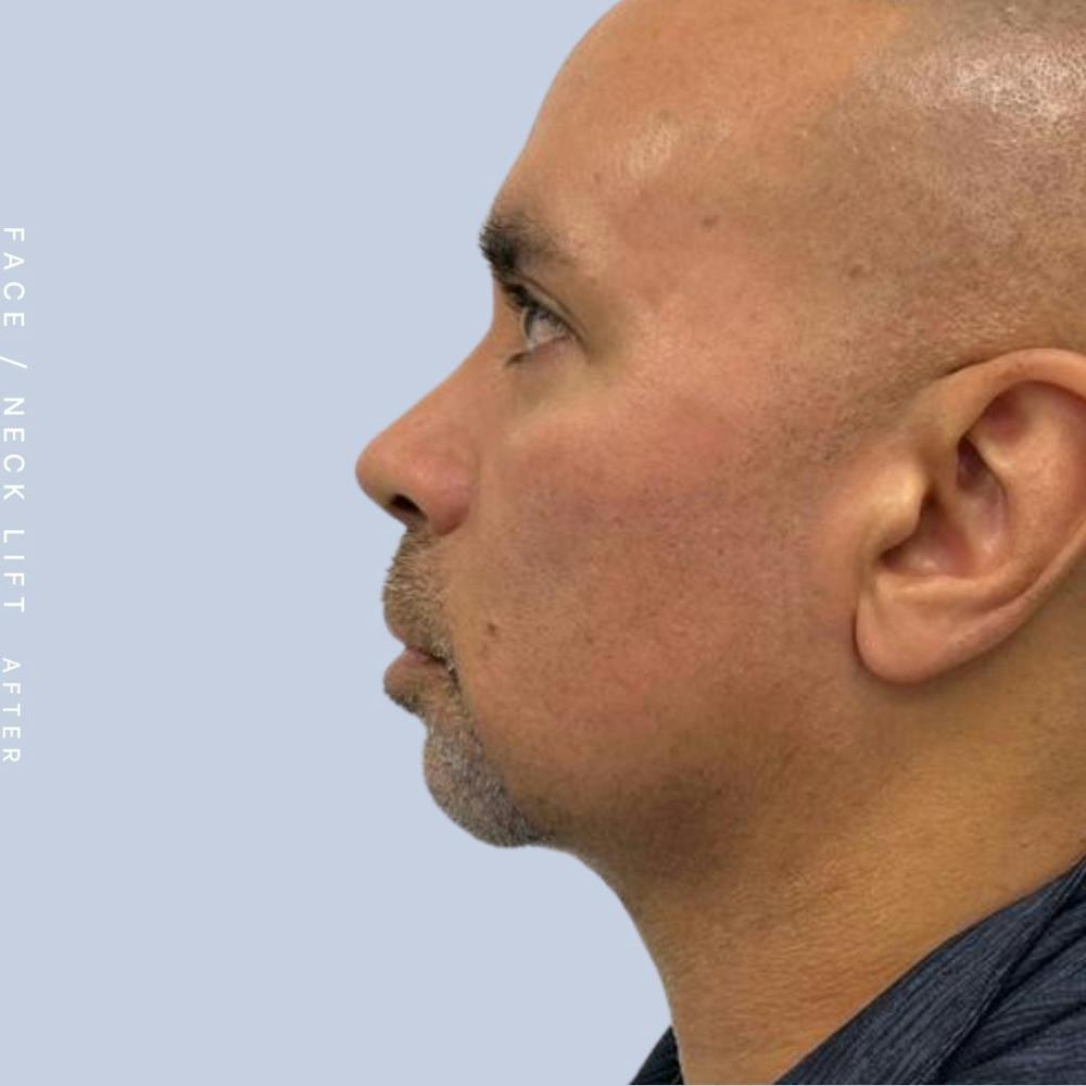 Face & Neck Before & After Gallery - Patient 108707435 - Image 2