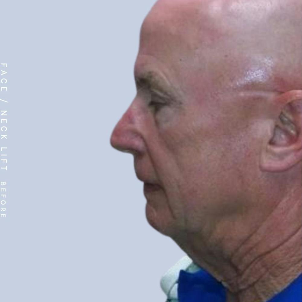 Men's Face & Neck Before & After Gallery - Patient 108763966 - Image 1