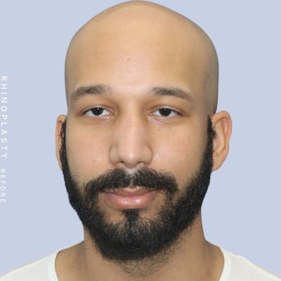 Nose Before & After Gallery - Patient 108743680 - Image 1