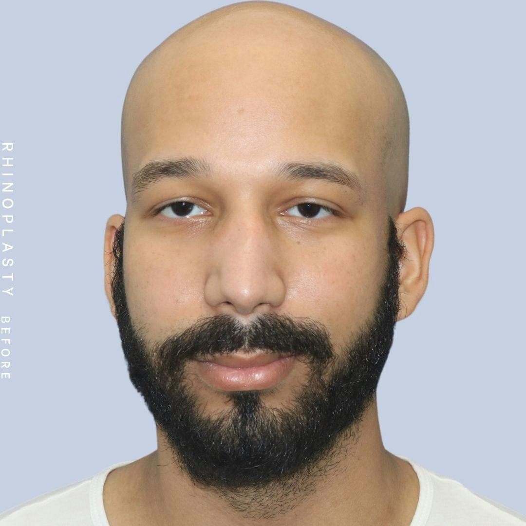 Nose Before & After Gallery - Patient 108743680 - Image 1