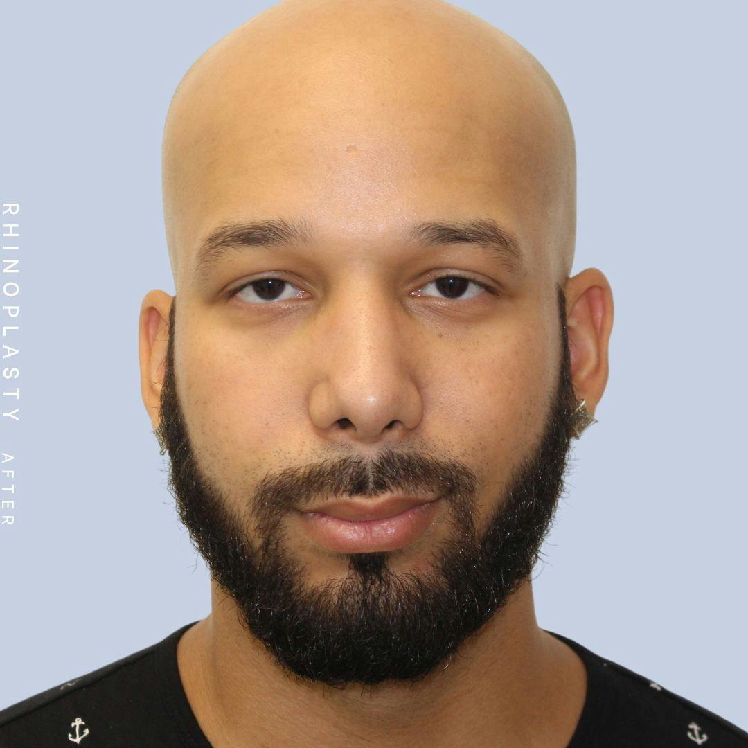 Nose Before & After Gallery - Patient 108743680 - Image 2