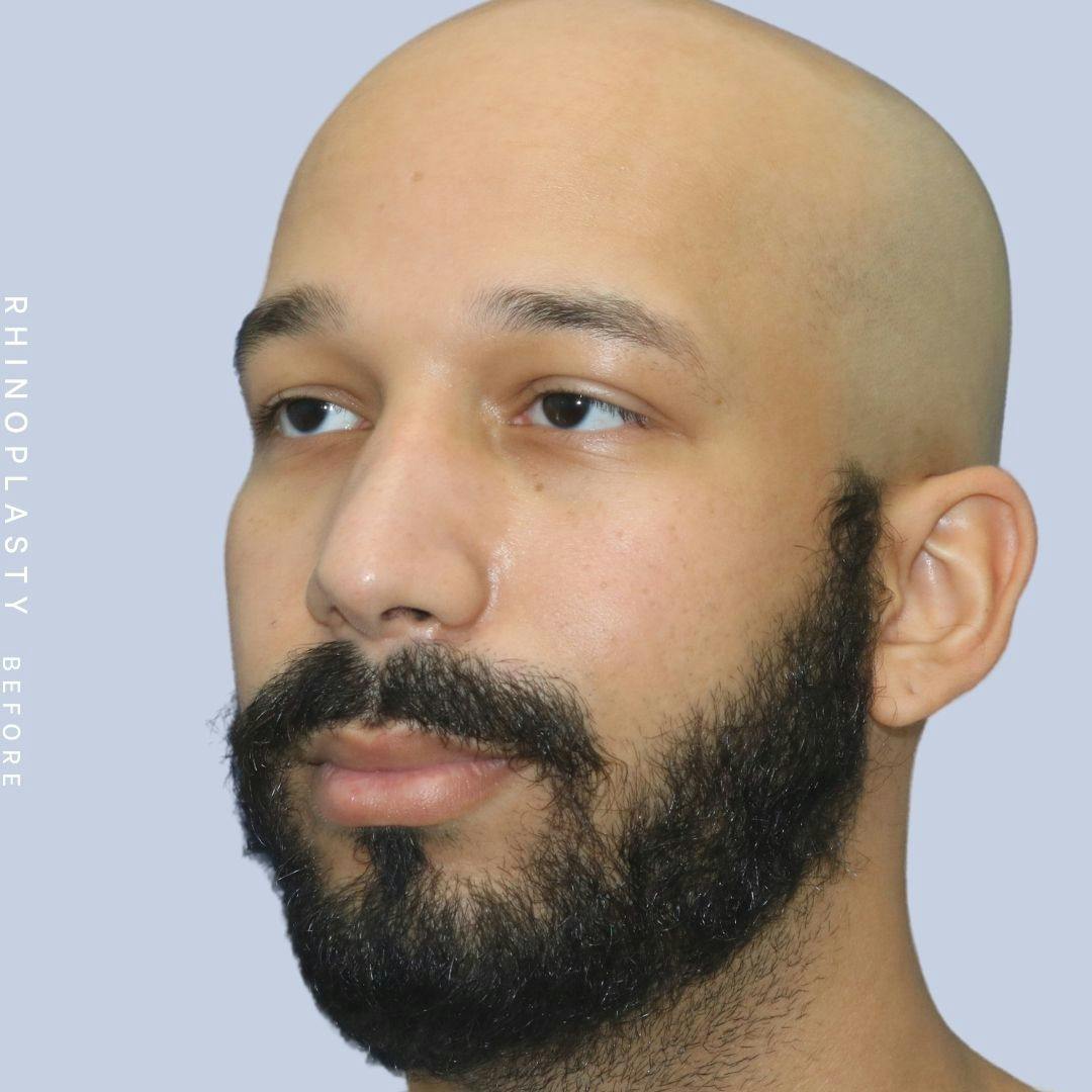 Nose Before & After Gallery - Patient 108743680 - Image 3