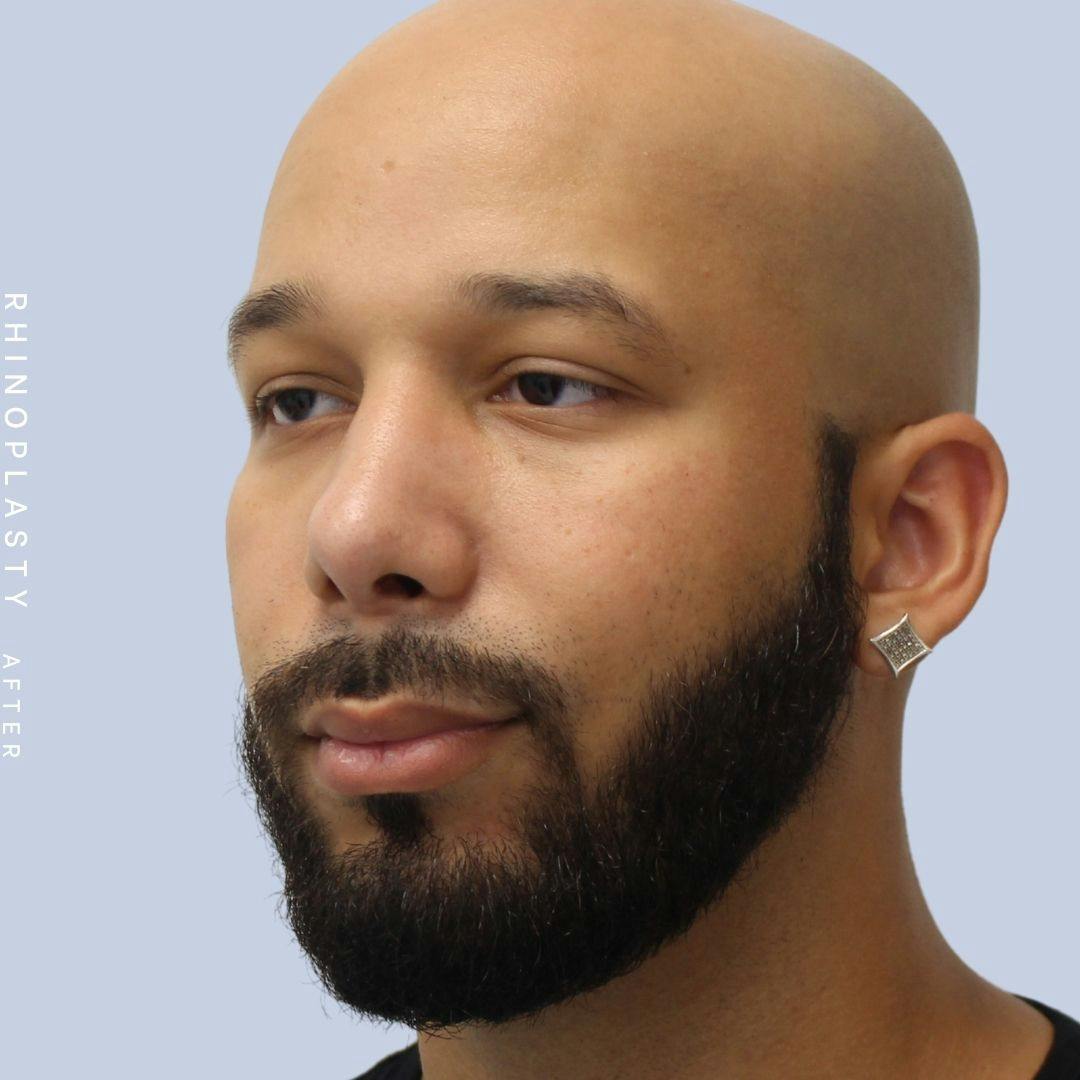 Nose Before & After Gallery - Patient 108743680 - Image 4