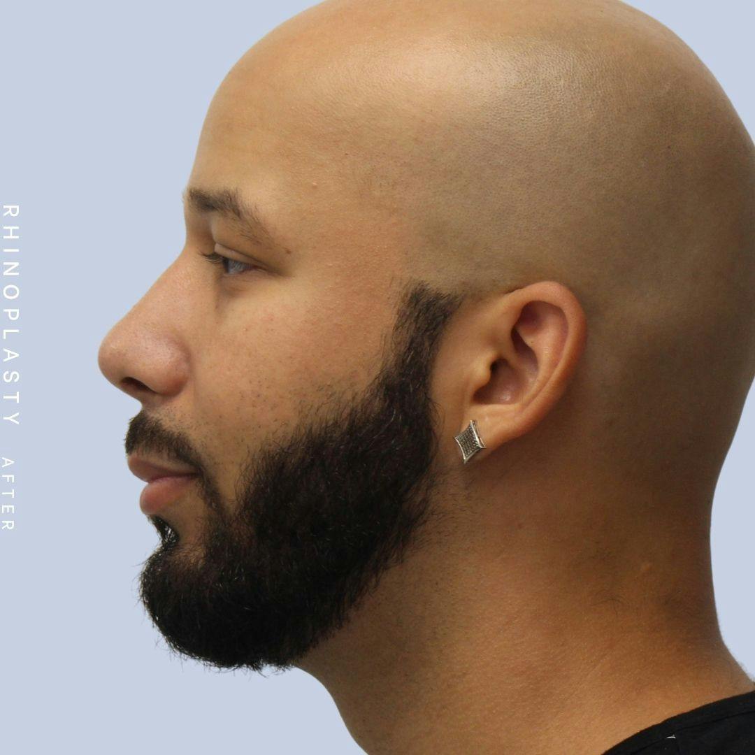 Nose Before & After Gallery - Patient 108743680 - Image 6