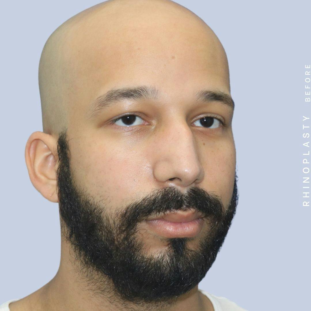 Nose Before & After Gallery - Patient 108743680 - Image 7