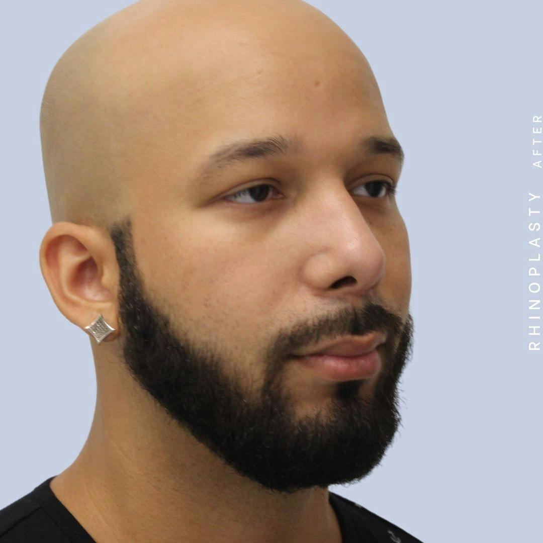 Nose Before & After Gallery - Patient 108743680 - Image 8