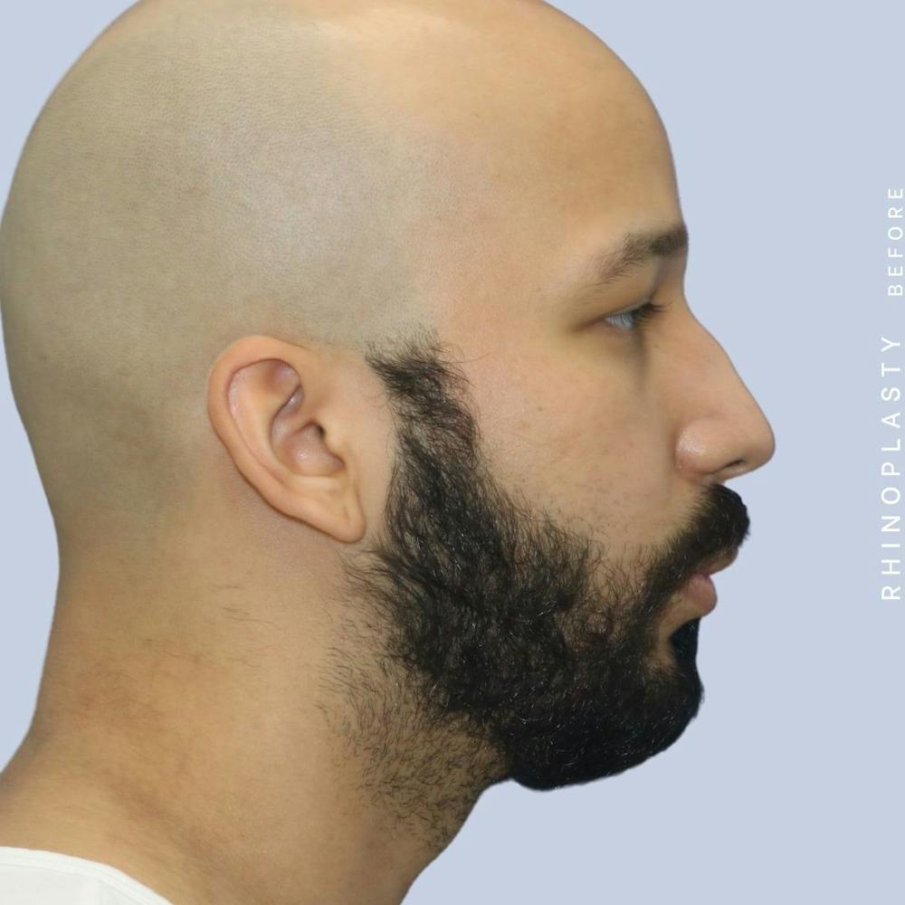 Men's Nose Before & After Gallery - Patient 108763901 - Image 9