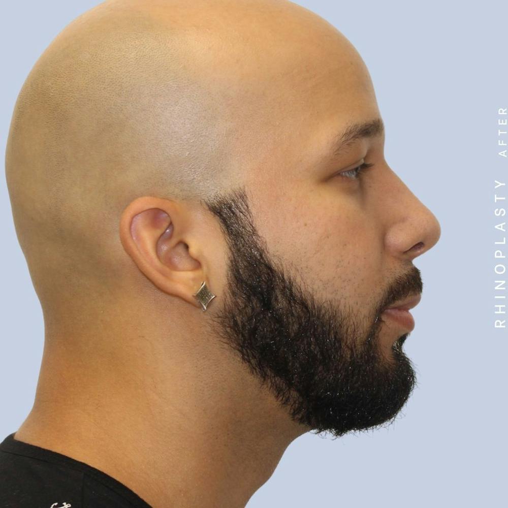 Nose Before & After Gallery - Patient 108743680 - Image 10